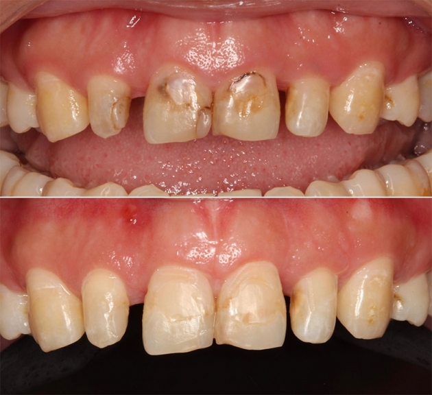 牙冠增長術改善笑齦，搭配全瓷貼片打造「完美微笑曲線」 4