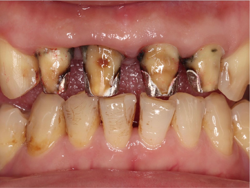 嚴重牙周病治療推薦: 療程包含全瓷冠/陶瓷貼片/植牙 4