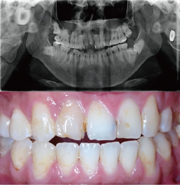舒眠植牙治療推薦: 包含根管治療後植牙/陶瓷貼片療程 2