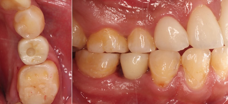 舒眠植牙治療推薦: 包含根管治療後植牙/陶瓷貼片療程 4