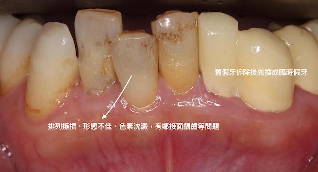 牙周病治療推薦: 療程包含全口牙周病/全瓷冠假牙/陶瓷貼片/植牙 2