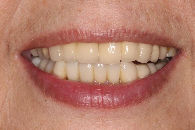牙周病治療推薦: 療程包含全口牙周病/全瓷冠假牙/陶瓷貼片/植牙 5