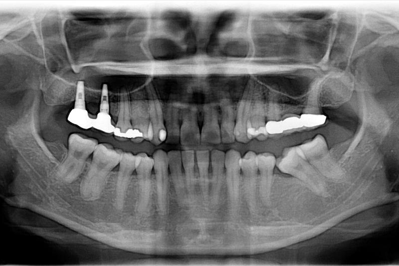 中度牙周病治療推薦 全口牙周病牙冠增長術鼻竇增高術 1