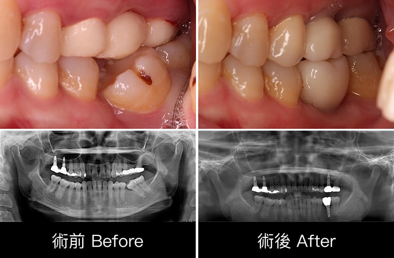 中度牙周病治療推薦 全口牙周病牙冠增長術鼻竇增高術 2