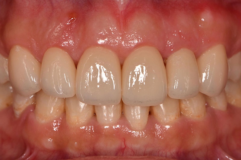 牙冠增長術改善笑齦，搭配全瓷貼片打造「完美微笑曲線」 5