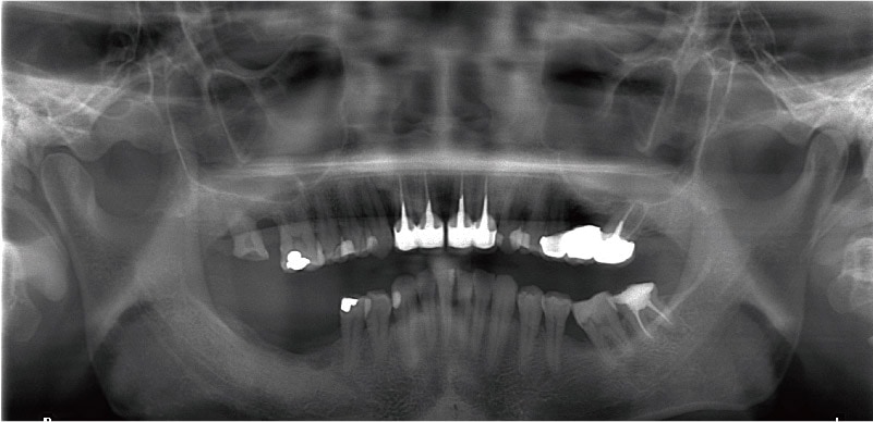 嚴重牙周病治療推薦: 療程包含全瓷冠/陶瓷貼片/植牙 2