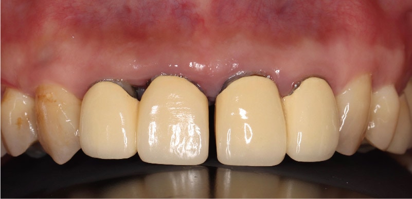 嚴重牙周病治療推薦: 療程包含全瓷冠/陶瓷貼片/植牙 3