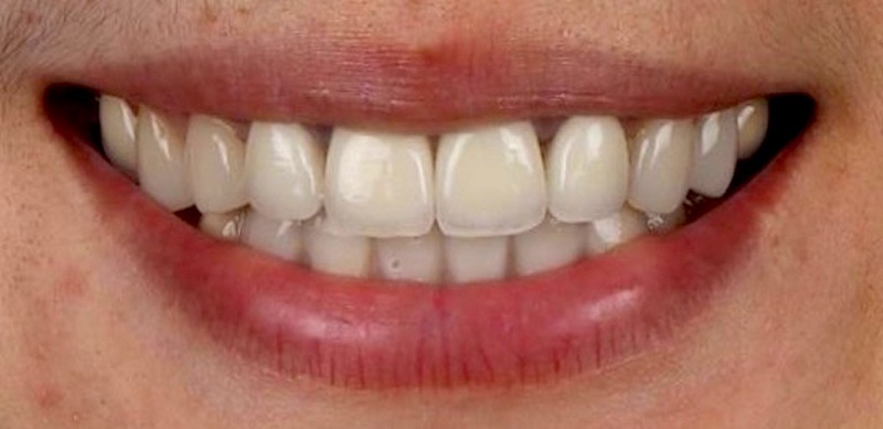 牙周病治療推薦:牙齒酸痛/牙齦萎縮治療/輕微牙周病/全瓷冠 3