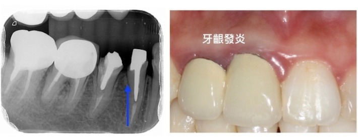 牙周病治療推薦:牙齒酸痛/牙齦萎縮治療/輕微牙周病/全瓷冠