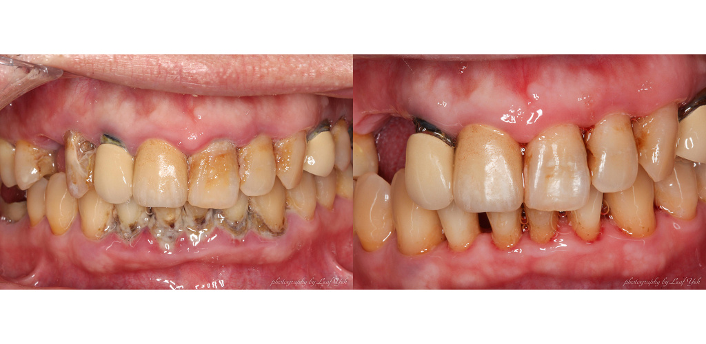 【心得分享】牙周病治療心得 植牙要成功，牙周健康是首要！