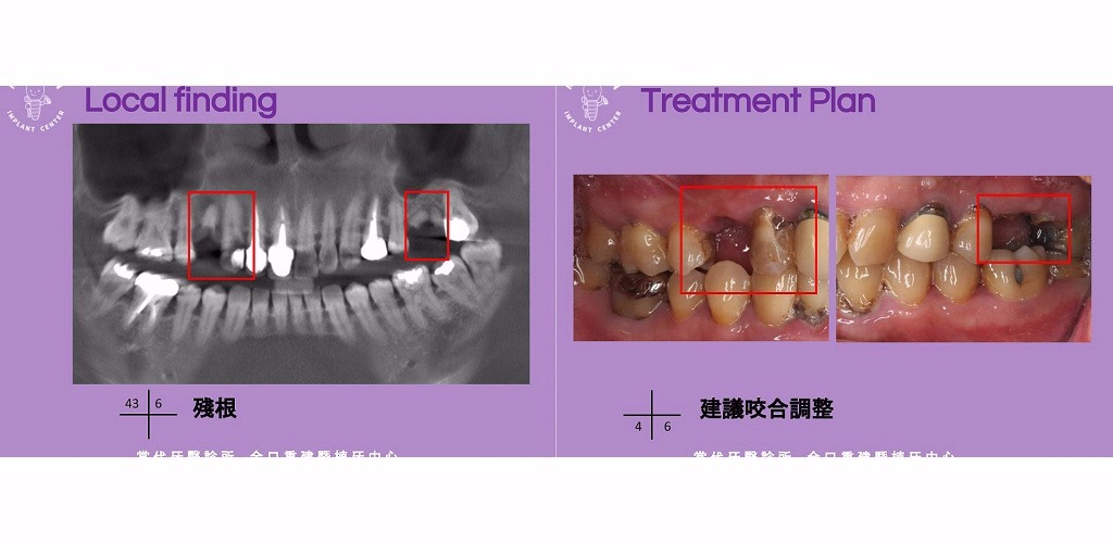 【心得分享】救救一口爛牙就先從面對開始！/植牙評估心得分享/中壢植牙
