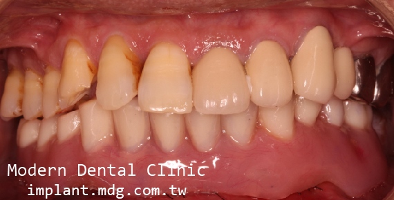 桃園當代牙醫 案例分享 王先生 All on 4 術後口內照