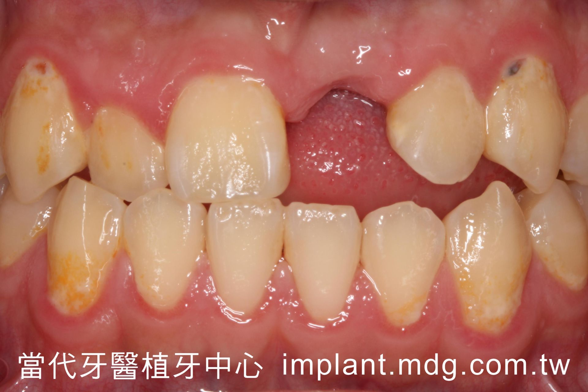 桃園中壢當代牙醫植牙中心 植牙專業 植牙案例真情分享 葉先生 術前口內照