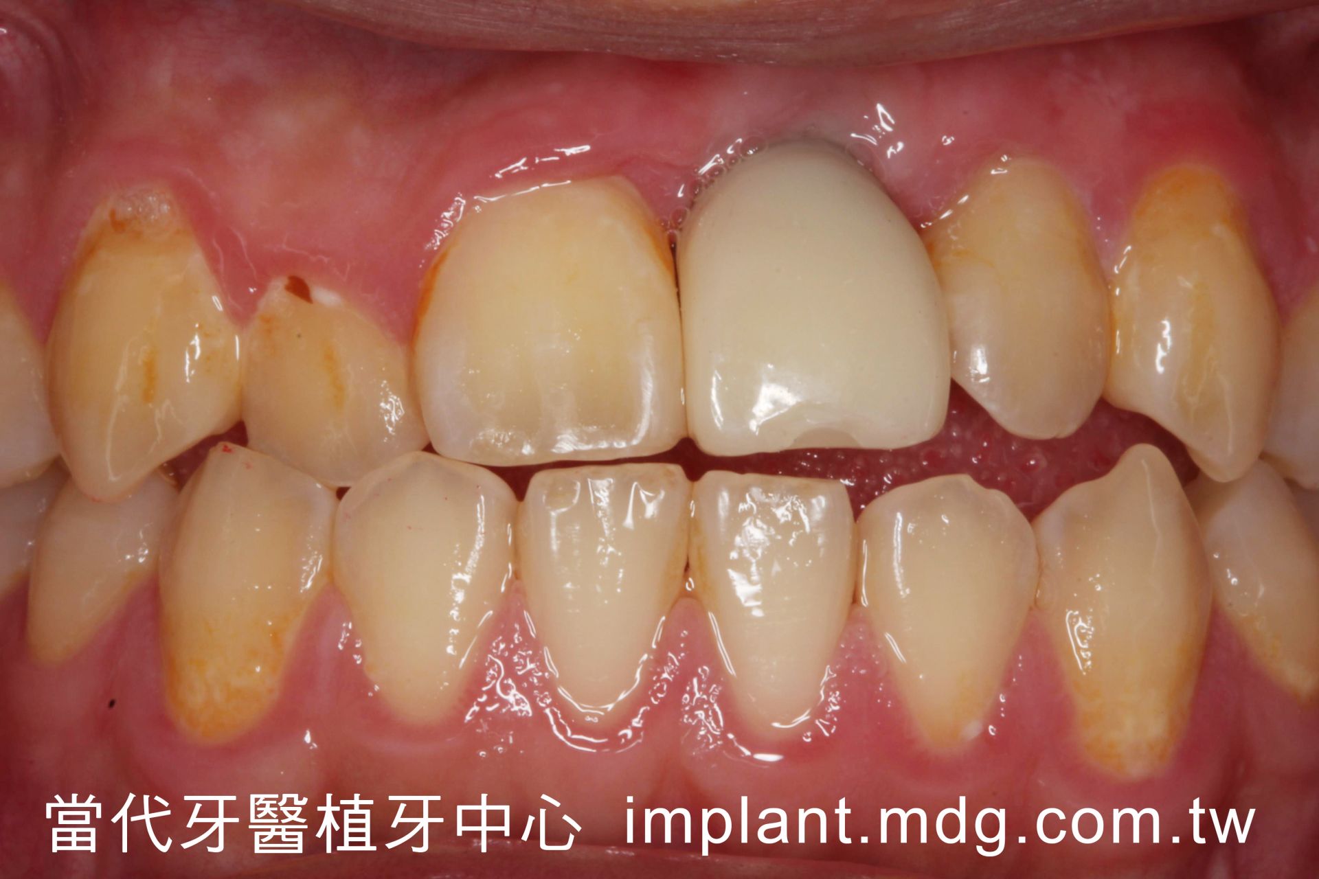 桃園中壢當代牙醫植牙中心 植牙專業 植牙案例真情分享 葉先生 術後口內照